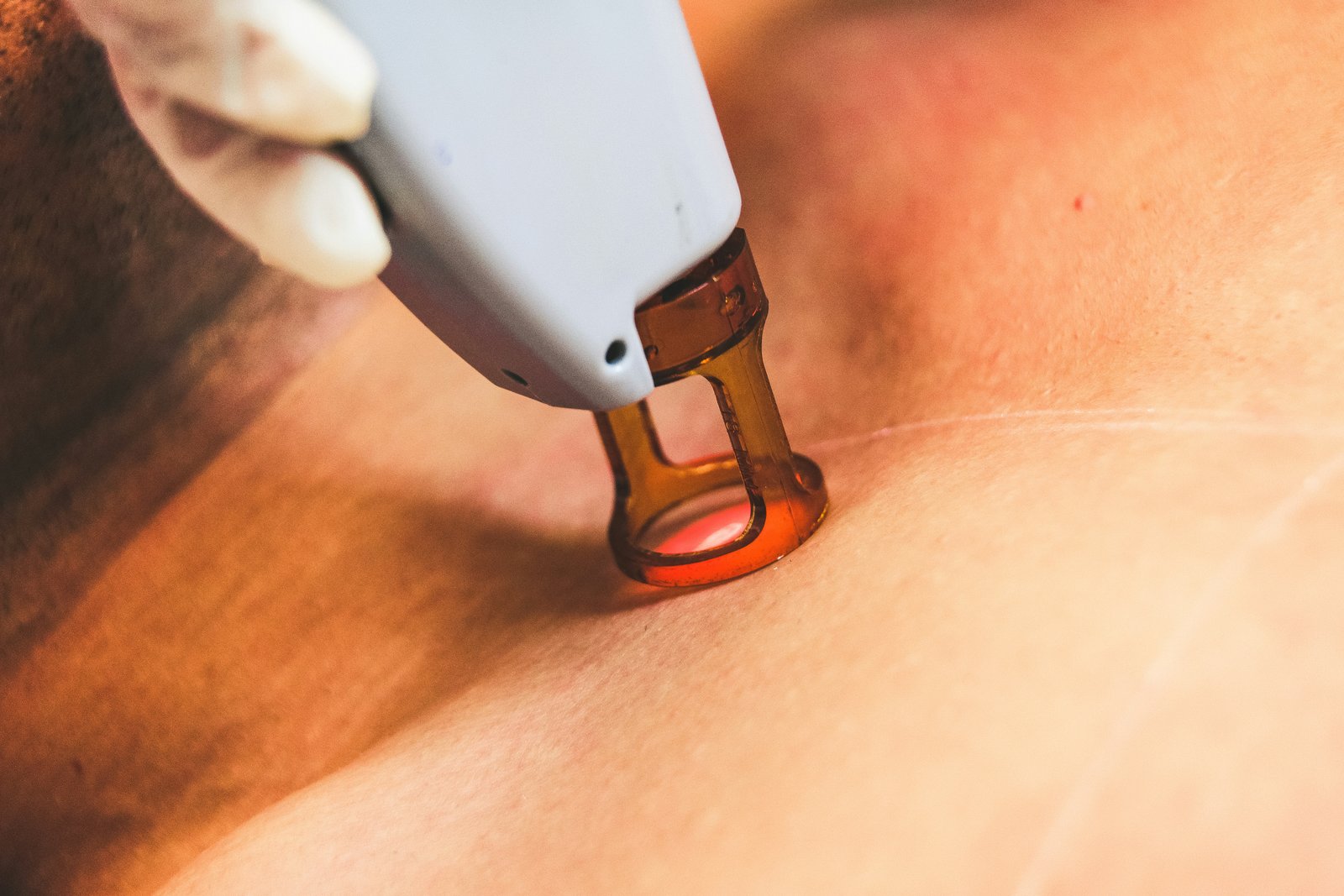 Épilation Laser